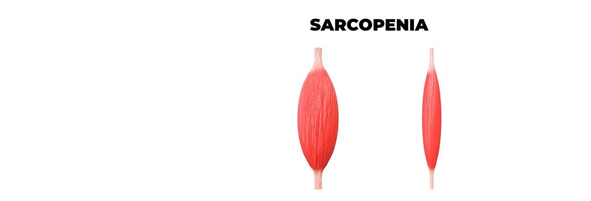 sarcopenia